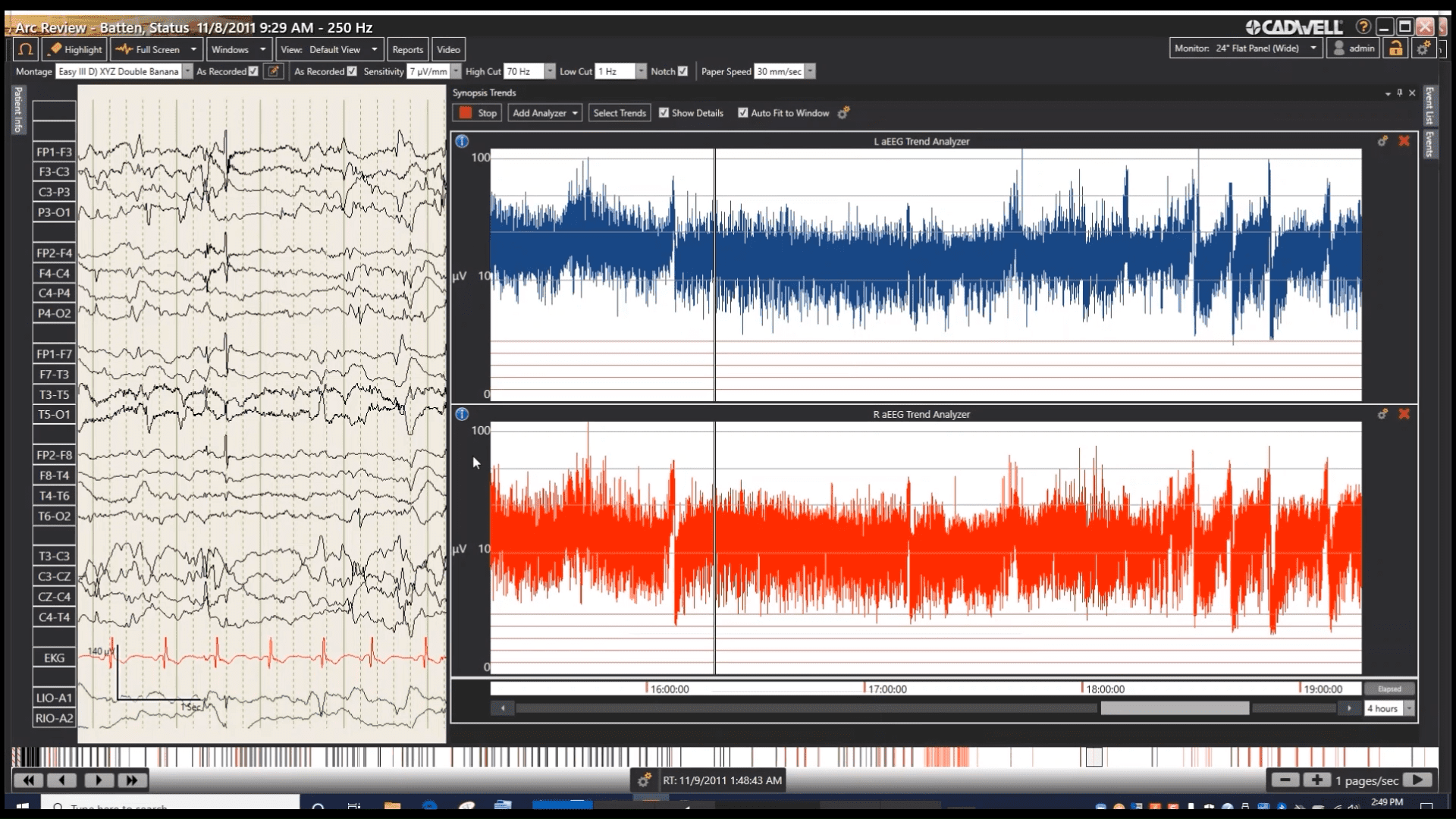 Amplitude Integrated EEG